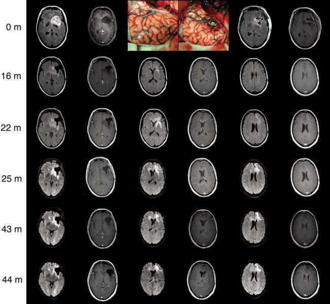 弥漫浸润性脑胶质瘤的手术治疗和认知功能影响