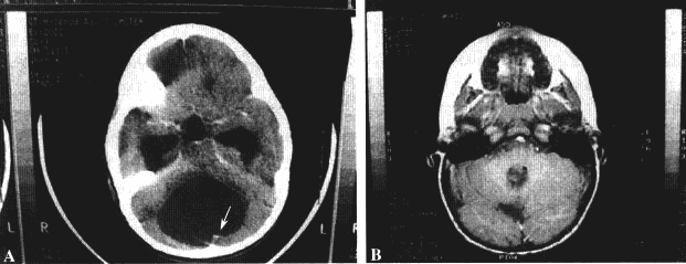 星形细胞瘤能活多久？