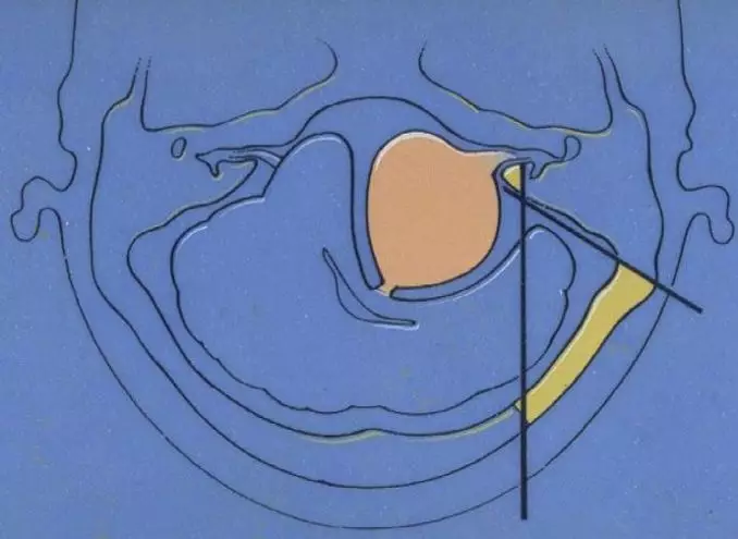 听神经瘤是大手术吗？听神经瘤枕下入路详述