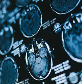 脊髓脊膜膨出是什么病？预后好吗？