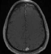 矢状窦脑膜瘤108例手术研究报告