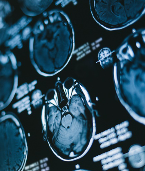 <a href='/bingzhong/jszl/' target='_blank'><u>脊髓肿瘤</u></a>