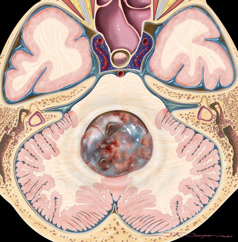 成人小脑肿瘤的外科治疗
