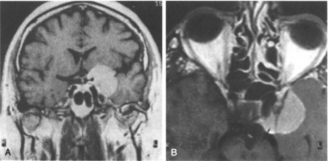 蝶骨嵴脑膜瘤能活多久？手术难度大吗？