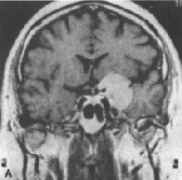 蝶骨嵴脑膜瘤能活多久？手术难度大吗？
