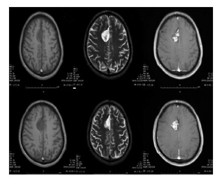 胶质神经元肿瘤