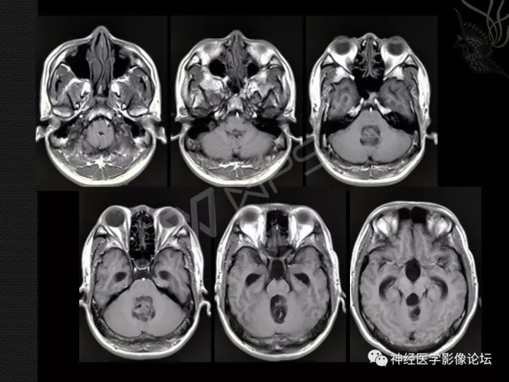 弥漫性脑膜胶质瘤