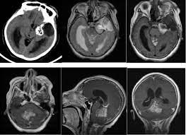 小脑脂肪神经细胞瘤