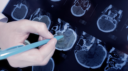 脑膜瘤会遗传吗？偶发脑膜瘤需要治疗吗？