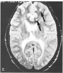 视神经胶质瘤-神经纤维瘤病案例2则