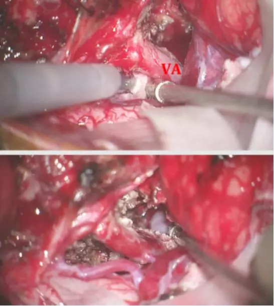 枕骨大孔区脑膜瘤的手术