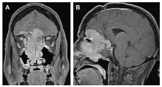 引起脑膜瘤的病因是什么？