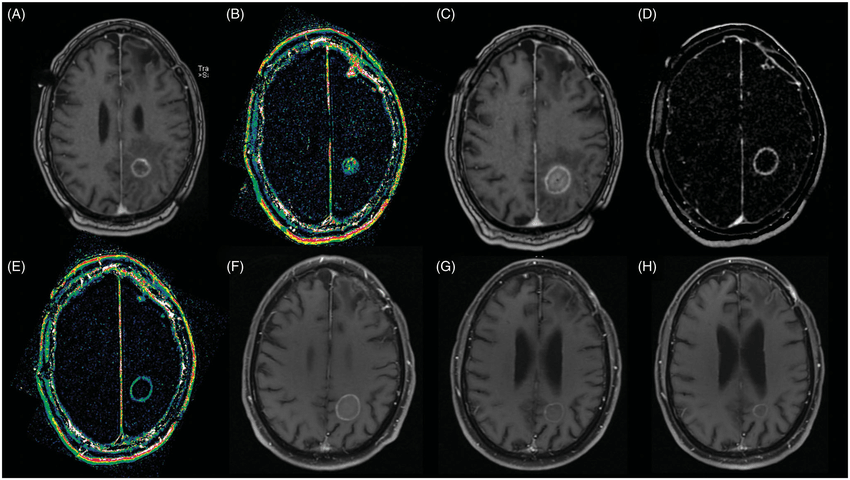 脑瘤复发几率有多大?