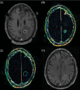 脑瘤复发几率有多大?