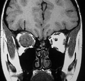 视神经胶质瘤的影像学诊断