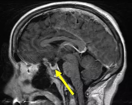 图文详解脑膜瘤特点和治疗