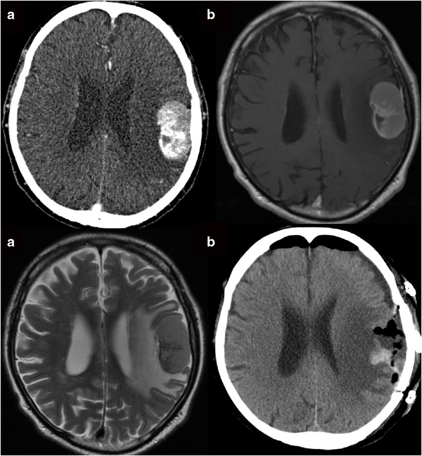 大脑凸面脑膜瘤属于几级？