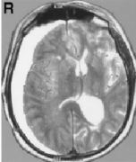 三叉神经周围动静脉畸形案例解读：手术还是放疗？