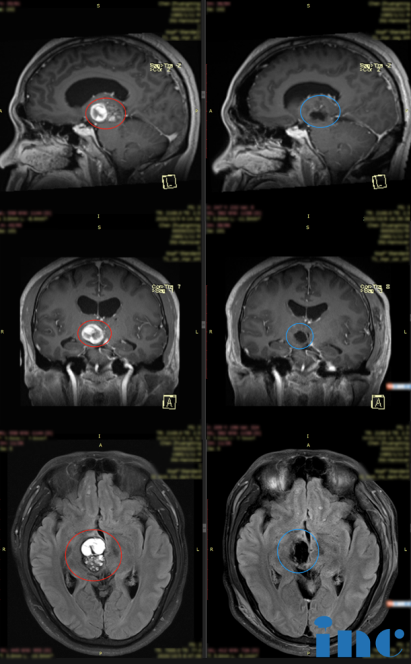 丘脑的较大脑干海绵状血管瘤