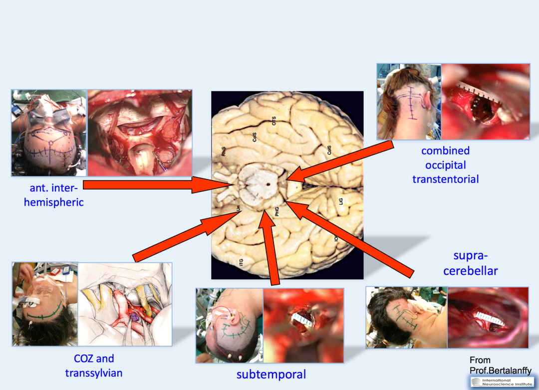 丘脑的较大脑干海绵状血管瘤