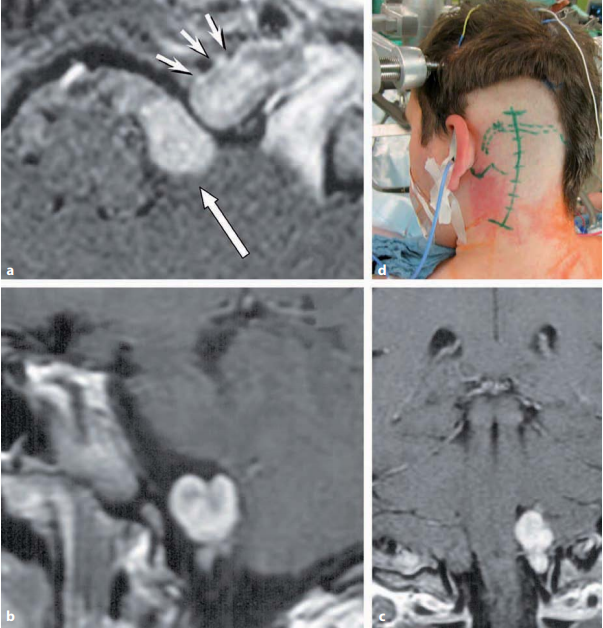 枕骨大孔区神经鞘瘤怎么治疗？INC德国巴特朗菲教授解读手术策略