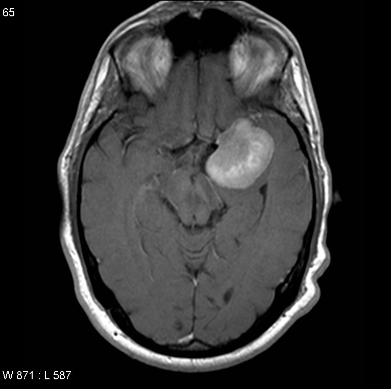 蝶骨翼脑膜瘤预后好吗？
