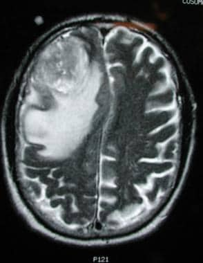 多形性胶质母细胞瘤的影像学诊断