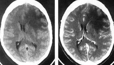 星形<a href='/bingzhong/jiaozhiliu/' target='_blank'><u>胶质瘤</u></a>