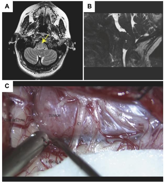 怀孕期间诊断出枕骨大孔区脑膜瘤怎么办？
