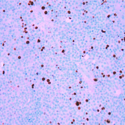 垂体腺瘤复发，和Ki-67指数有关？