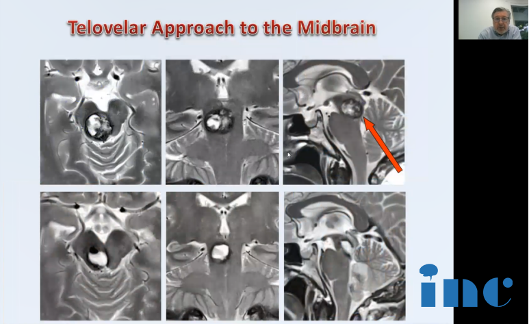 巴特朗菲教授手术案例