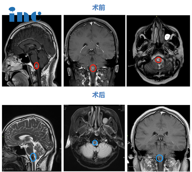 脑干延髓海绵状血管瘤术前