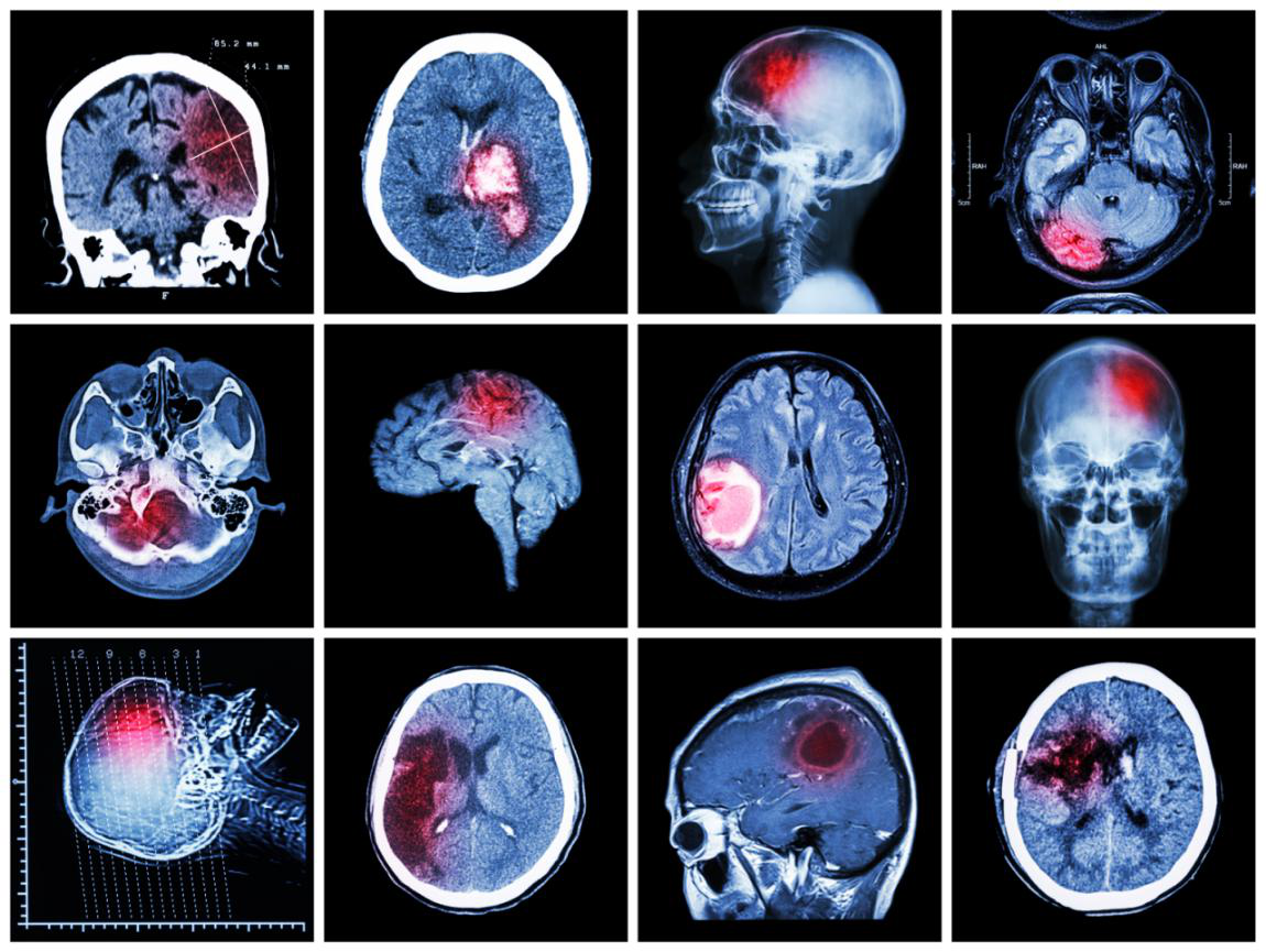 什么是非典型脑膜瘤？