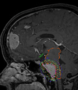 脑膜瘤放疗后能恢复吗？