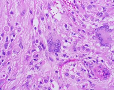 多形性黄色星形细胞瘤