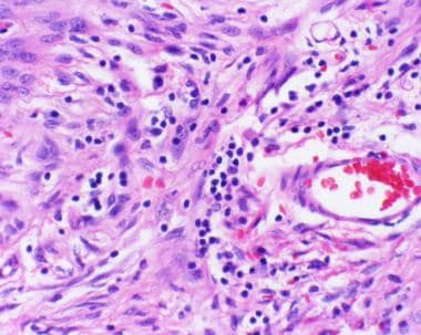 多形性黄色星形细胞瘤