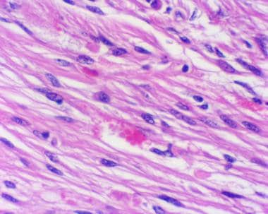 多形性黄色星形细胞瘤