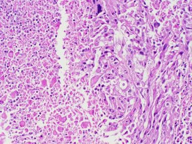 多形性黄色星形细胞瘤