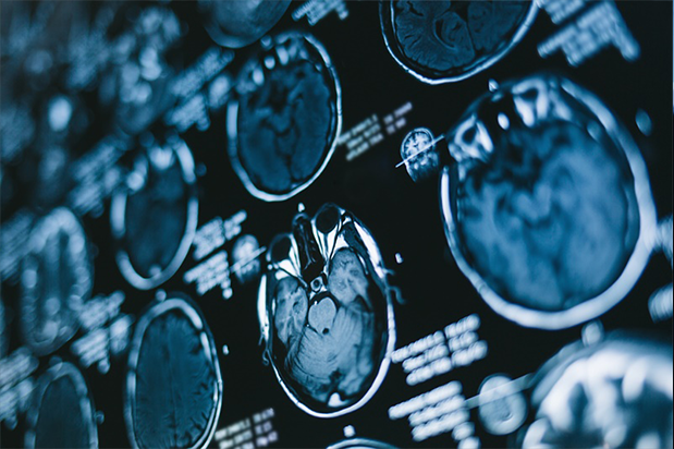 低级别胶质瘤能自愈吗？