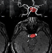 脑动脉瘤一旦破裂有哪些症状？