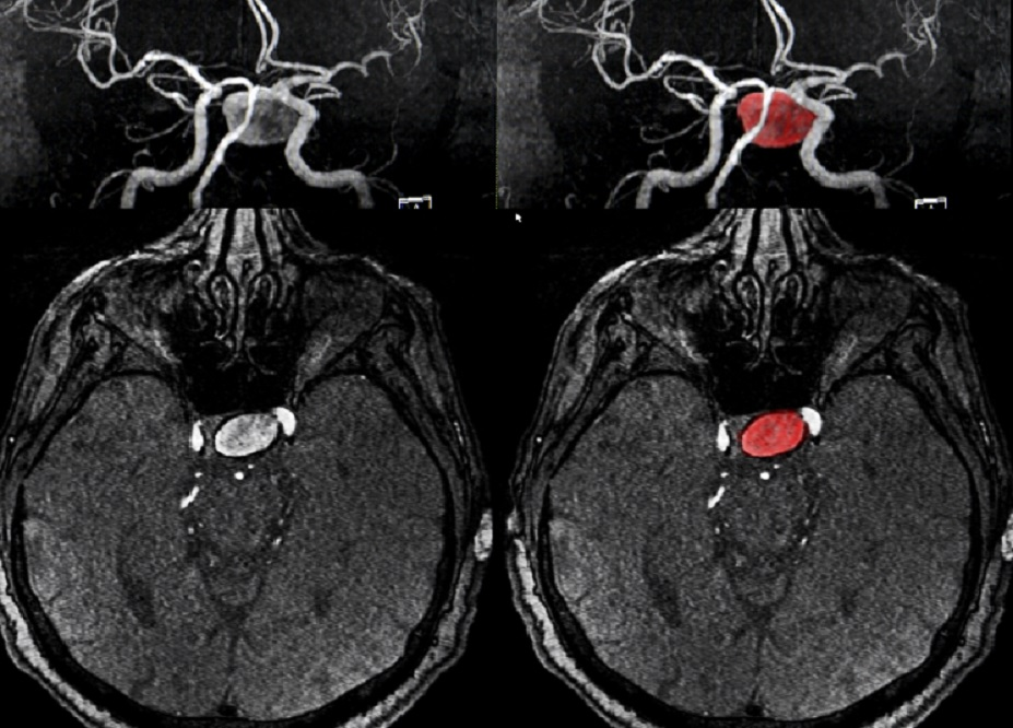 <a href='/baike/naodongmailiu.html' target='_blank'><u>脑动脉瘤</u></a>一旦破裂有哪些症状？