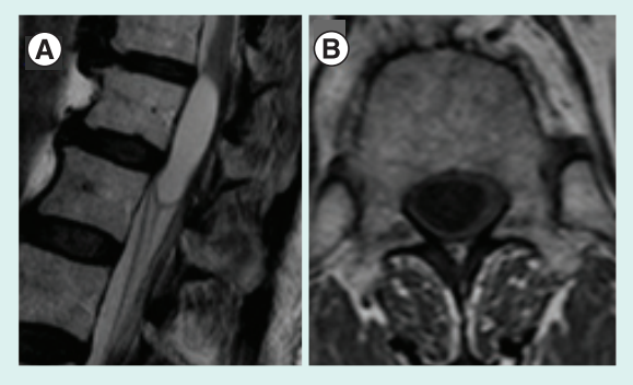 成人延髓毛细细胞星形细胞瘤