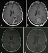 胶质母细胞瘤的治疗方案:手术切除程度对患者生活质量的影响