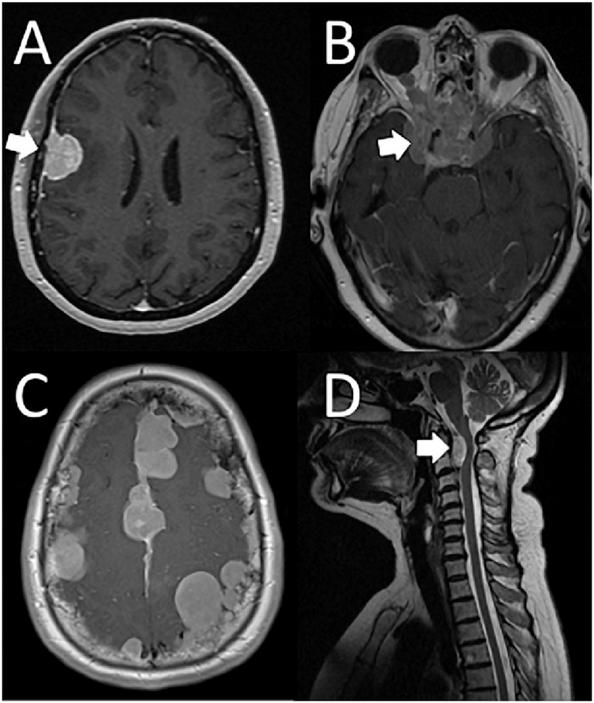 脑膜瘤怎样形成的？脑膜瘤诊断和治疗指南