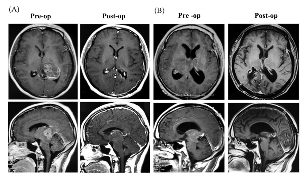 丘脑胶质瘤能治好吗？