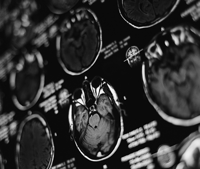 听神经瘤术后并发症有哪些？面瘫及听力损失可以避免吗？