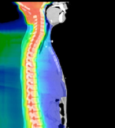 问：儿童脑瘤手术做好了，治疗就成功了？