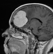 脑膜瘤严重吗？颅内脑膜瘤的手术治疗