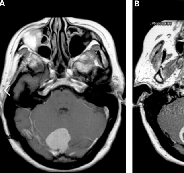 脑膜瘤手术技术注意事项