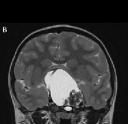 颅咽管瘤复发了有什么治疗手段？